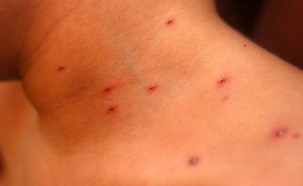 La varicela es causada por el virus varicela-zóster. Foto: Cuauhtémoc Moreno Cabrera / Cortesía