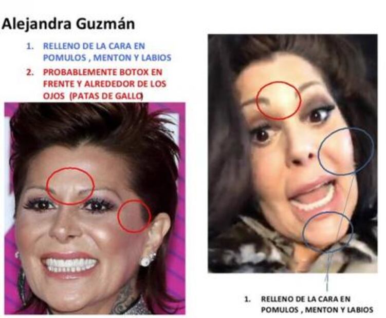 El bótox cambia la cara de Guzmán 