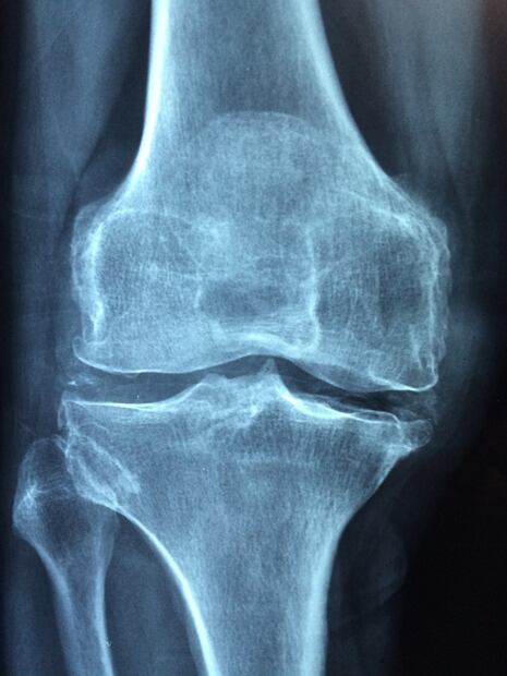 Prevención de la osteoporosis. Fuente: Pixabay