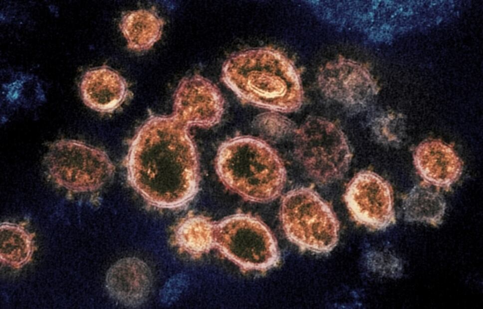 Personas con síndrome de Down son genéticamente susceptibles al Covid-19