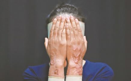 Senado avala hasta 13 años de cárcel por ataques con ácido contra mujeres