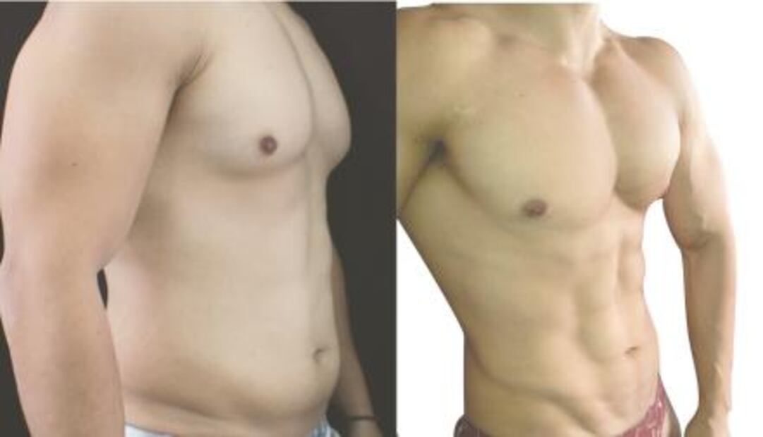 Hombres, fans de la estética y el bisturí 