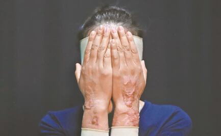 Denuncian ataque con ácido a una mujer en Puebla