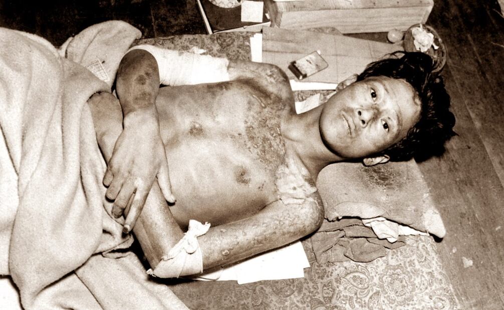 Víctima de la bomba atómica tirada en Nagasaki en 1945. Más de 200 mil personas padecieron algún daño por los bombardeos nucleares, varios de ellos fallecieron con el paso de los años, con un grave deterioro en su salud a causa de la radiación. ESPECIAL/Wikimedia Commons.
