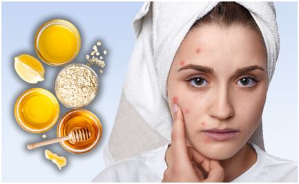 Los mejores remedios caseros para eliminar las marcas de acné