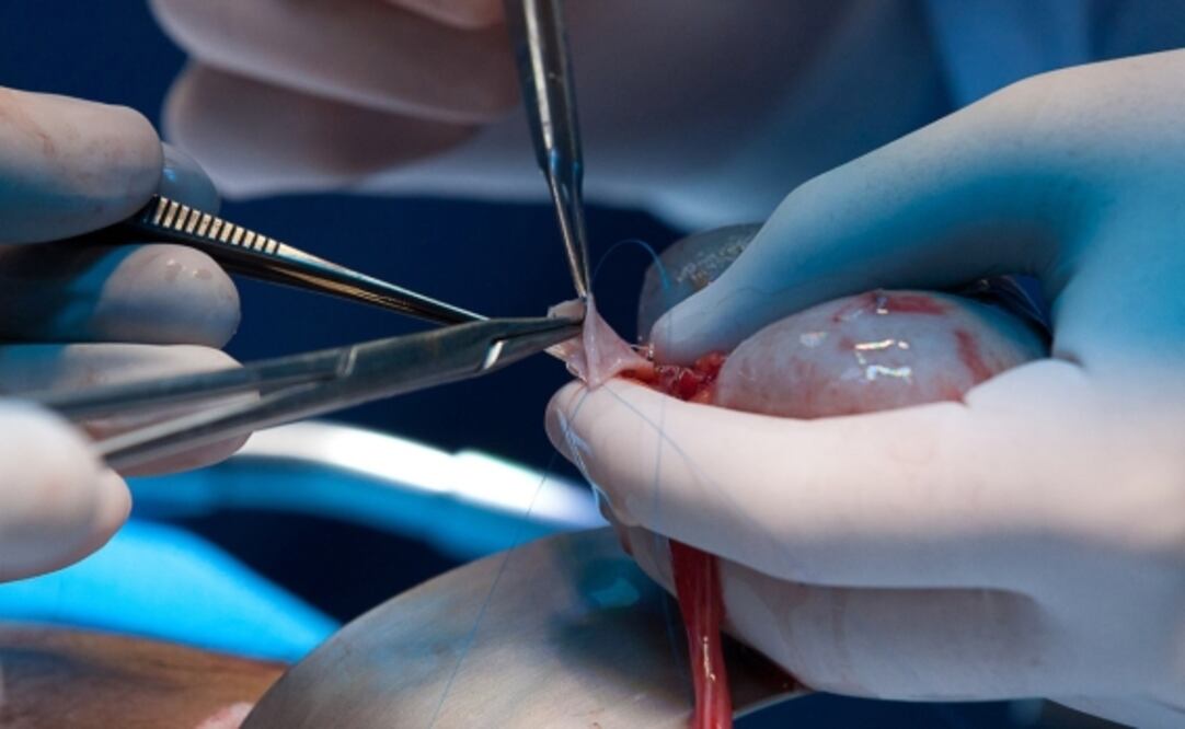 En otros transplantes de órganos de cerdos modificados se incorporaban hasta 10 modificaciones genéticas, pero en este estudio se usó un riñón con solo un gen modificado específicamente y ha funcionado por un mes.