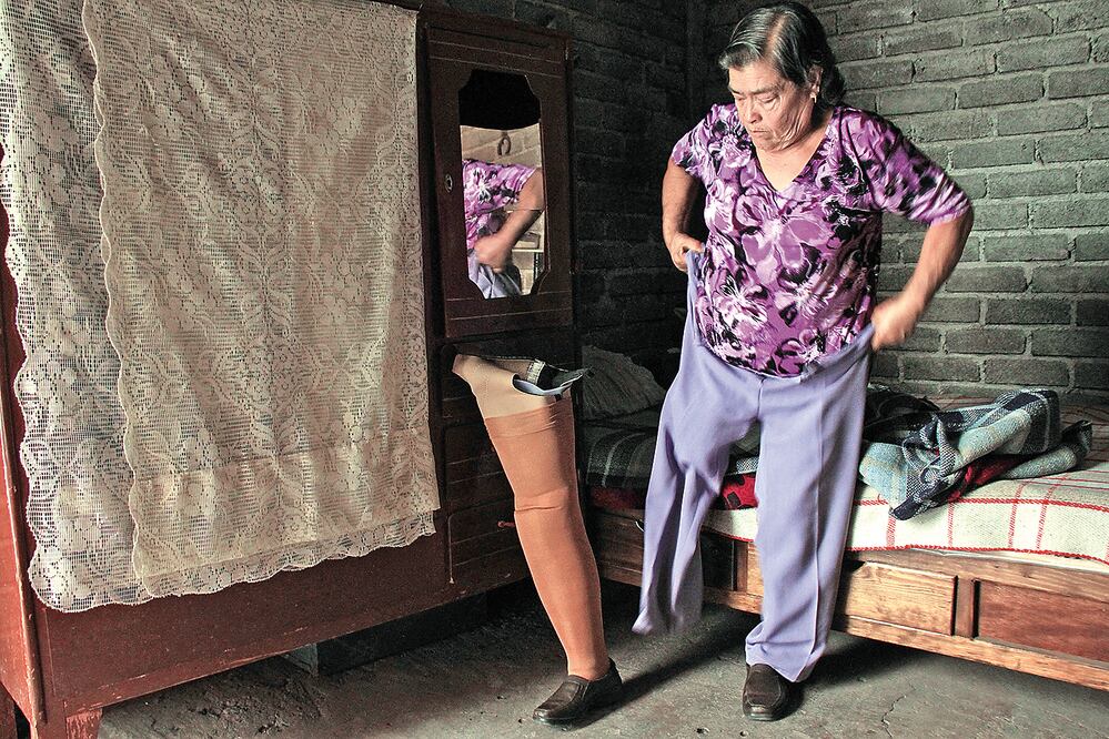 Rita Alvarado perdió su pierna derecha en el granadazo (RAÚL TINOCO / EL UNIVERSAL)