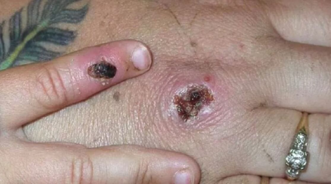 Viruela del mono. Expertos explican por qué no será una pandemia como la del Covid-19 