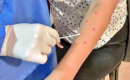 Detectan primer caso de Mpox en Morelos; Secretaría de Salud dice que no hay riesgo alto de contagio