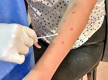 Detectan cuatro nuevos casos de mpox en Baja California Sur