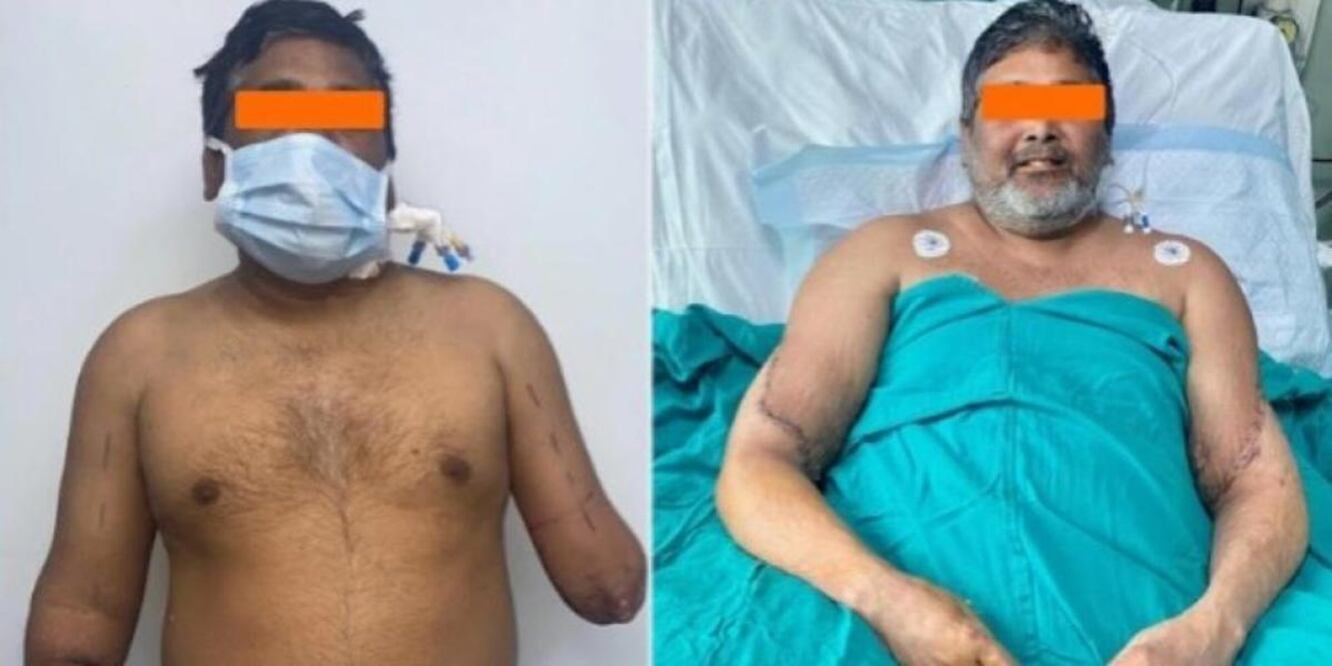 Raj Kumar perdió sus dos brazos en un accidente de tren en 2020. Fue sometido a un trasplante bilateral de mano. FOTO:
@sgrhindia