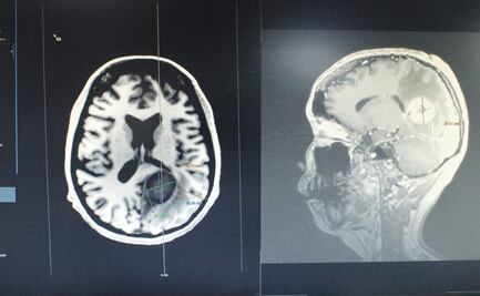 Iba por la vesícula; le retiran tumor del tamaño de un huevo