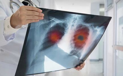 Covid-19 persistente desencadenaría enfermedad pulmonar, independiente de la infección