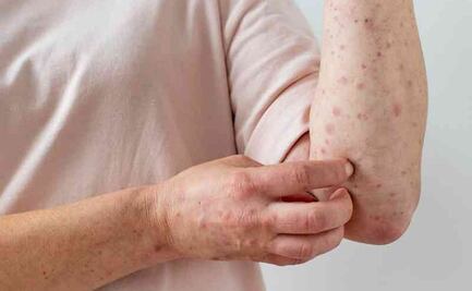 Reportan segundo caso de viruela del mono en profesor de primaria en Saltillo, Coahuila