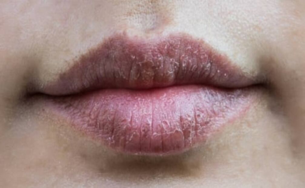Razones por las que se parten los labios y cómo evitarlo
