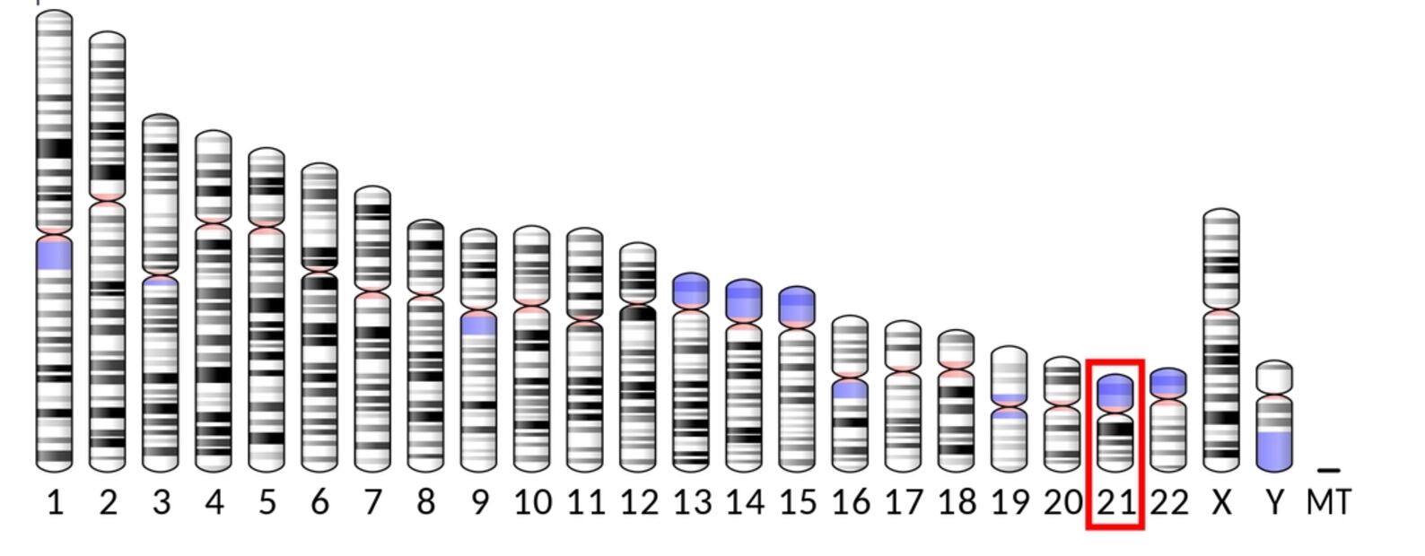 ¿Qué es el Síndrome DYRK1A?; conoce sus principales síntomas y qué cromosoma afecta