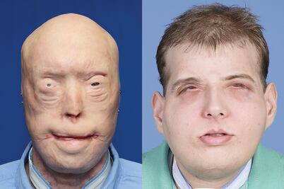 En NY, el trasplante de cara más complejo hasta hoy