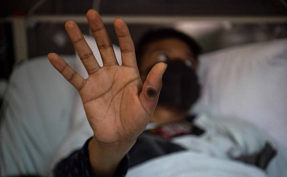 En al menos 13 países africanos han registrado casos de mpox en lo que va de 2024. Foto: AFP