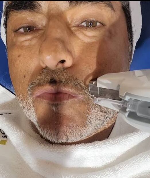 Raúl Araiza se somete a procedimiento estético en el rostro y lo presume en redes