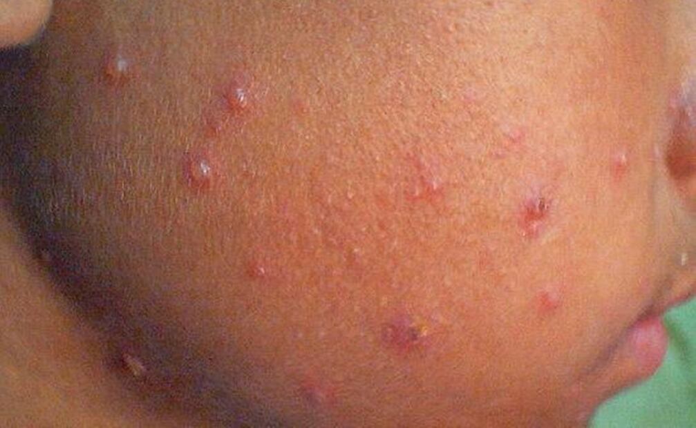Varicela. Foto: Especial 
