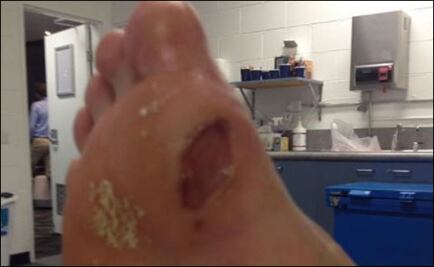 Así terminó el pie de Hyeon Chung después del Australian Open