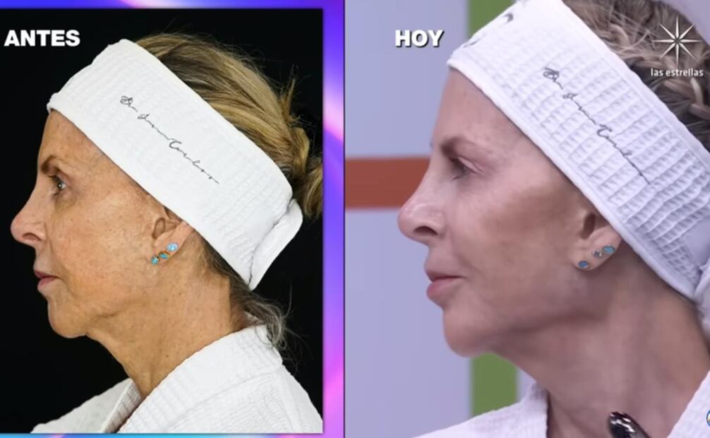 El antes y el después de Shanik Berman tras tratamiento estético.