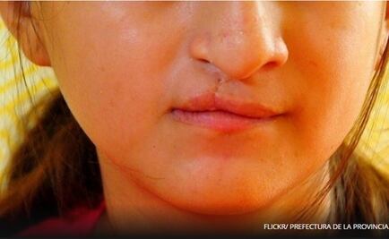 Identifican mutaciones responsables del labio leporino