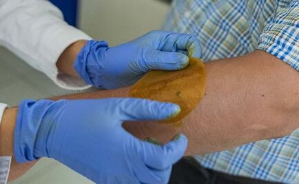 Desarrollan en la UNAM parche para regenerar la piel de diabéticos