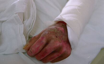 Diputada del PT propone hasta 15 años de cárcel a quien cause lesiones con ácidos