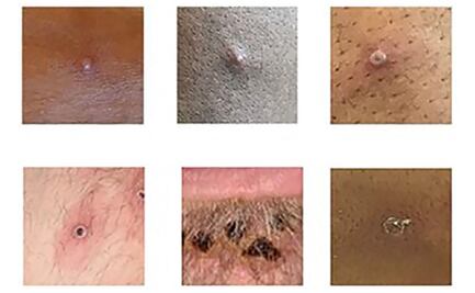 Preocupante acelerada mutación de la viruela del mono; hasta ahora detectan 50 variaciones genéticas