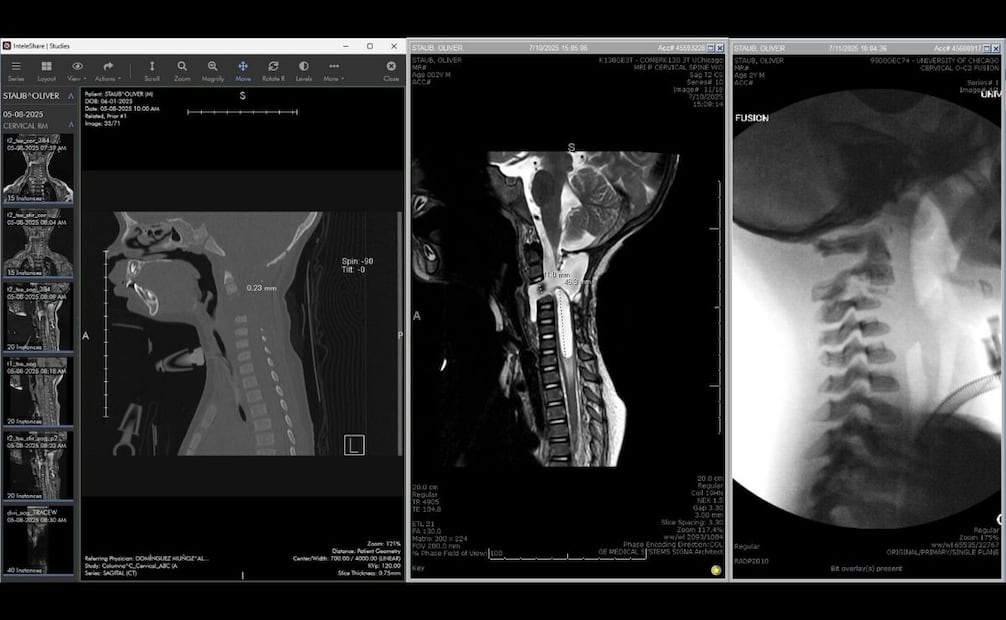 Radiografías de las lesiones de Oliver Staub previo a su intervención quirúrgica en Chicago. De lado izquierdo se aprecia la separación entre las cervicales del menor y el resto de su columna. Foto: Cortesía Dr. Mohamad Bydon.