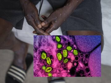 La OMS advierte probabilidad de nuevos brotes de mpox en Europa, tras detección de caso en Suecia